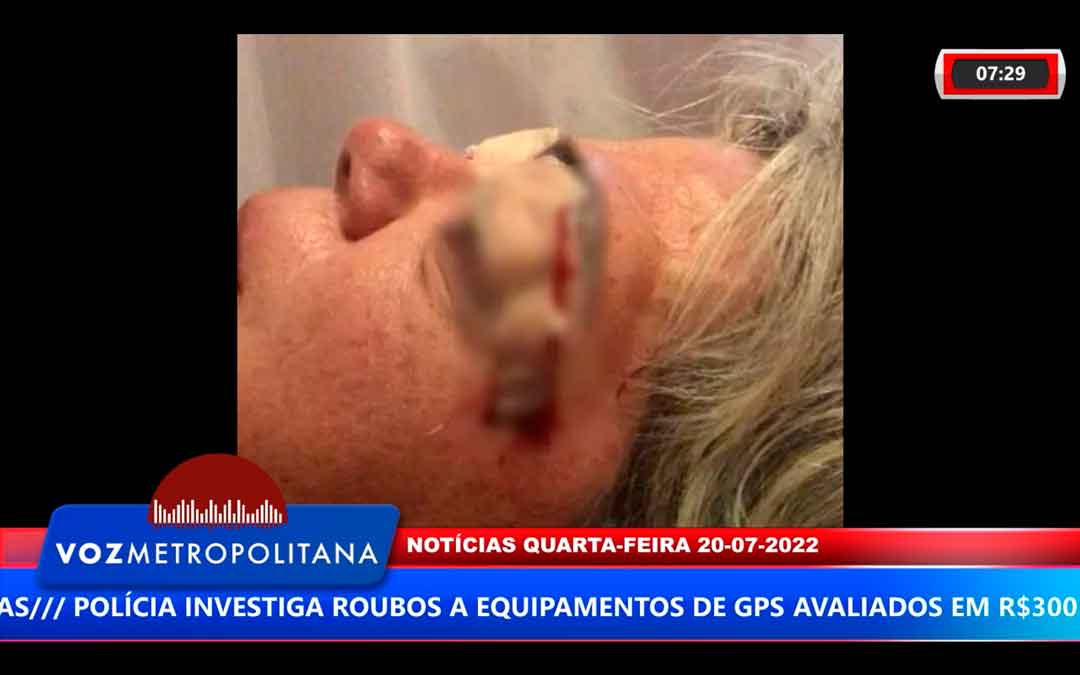 Mulher De Franca Acusa Dermatologista Por Erro Médico Em Cirurgia Para Retirar Excesso De Pele De Pálpebras