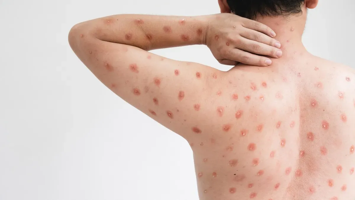 Ribeirão Preto registra nove casos confirmados de Mpox em 2025 até meados de julho