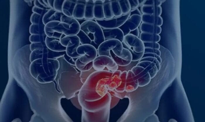 Estudo lançado na data nacional contra o câncer aponta excesso de diagnósticos avançados de câncer colorretal