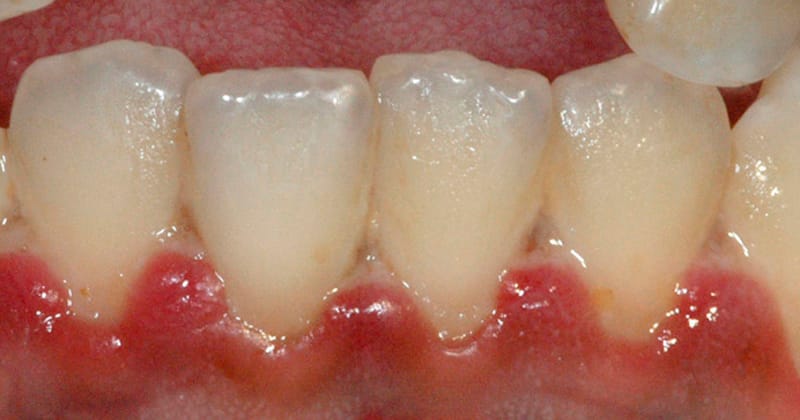 Forp da USP recruta voluntários para estudo sobre tratamento de doenças gengivais