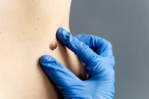 Hospital de Amor identifica genes que indicam resistência à imunoterapia no melanoma