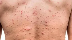 Ribeirão Preto confirma oito casos de Mpox em 2025 e reforça orientações de prevenção