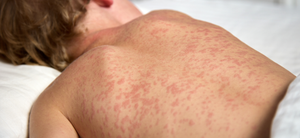 Setembro liderou notificações de sarampo em Ribeirão Preto; três casos ainda são investigados