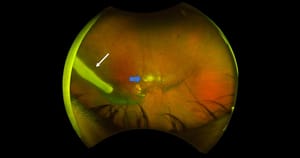 Novo implante intraocular testado em Ribeirão Preto controla toxoplasmose e dispensa antibiótico oral nos primeiros casos