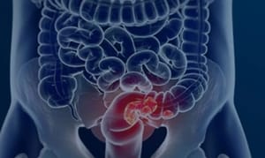 Estudo lançado na data nacional contra o câncer aponta excesso de diagnósticos avançados de câncer colorretal