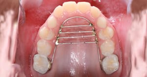 Forp abre inscrições para seleção de crianças que precisam de aparelho ortodôntico