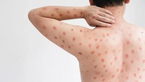 Ribeirão Preto registra dois casos confirmados de Mpox neste ano, diz prefeitura