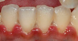 Forp da USP recruta voluntários para estudo sobre tratamento de doenças gengivais