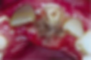 Idosa internada com infestação de larvas passa por cirurgia e se recupera em Santa Casa de Ribeirão Preto