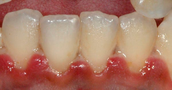 Forp da USP recruta voluntários para estudo sobre tratamento de doenças gengivais